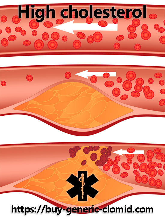 high cholesterol