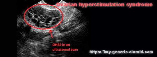 ovarian hyperstimulation syndrome